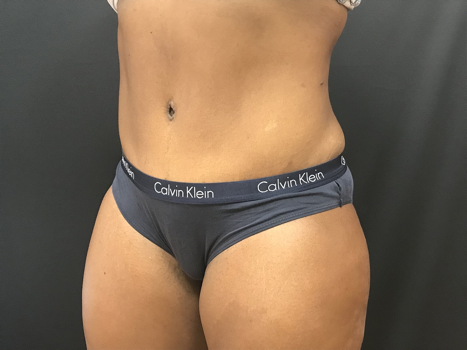 Tummy Tuck Before & After