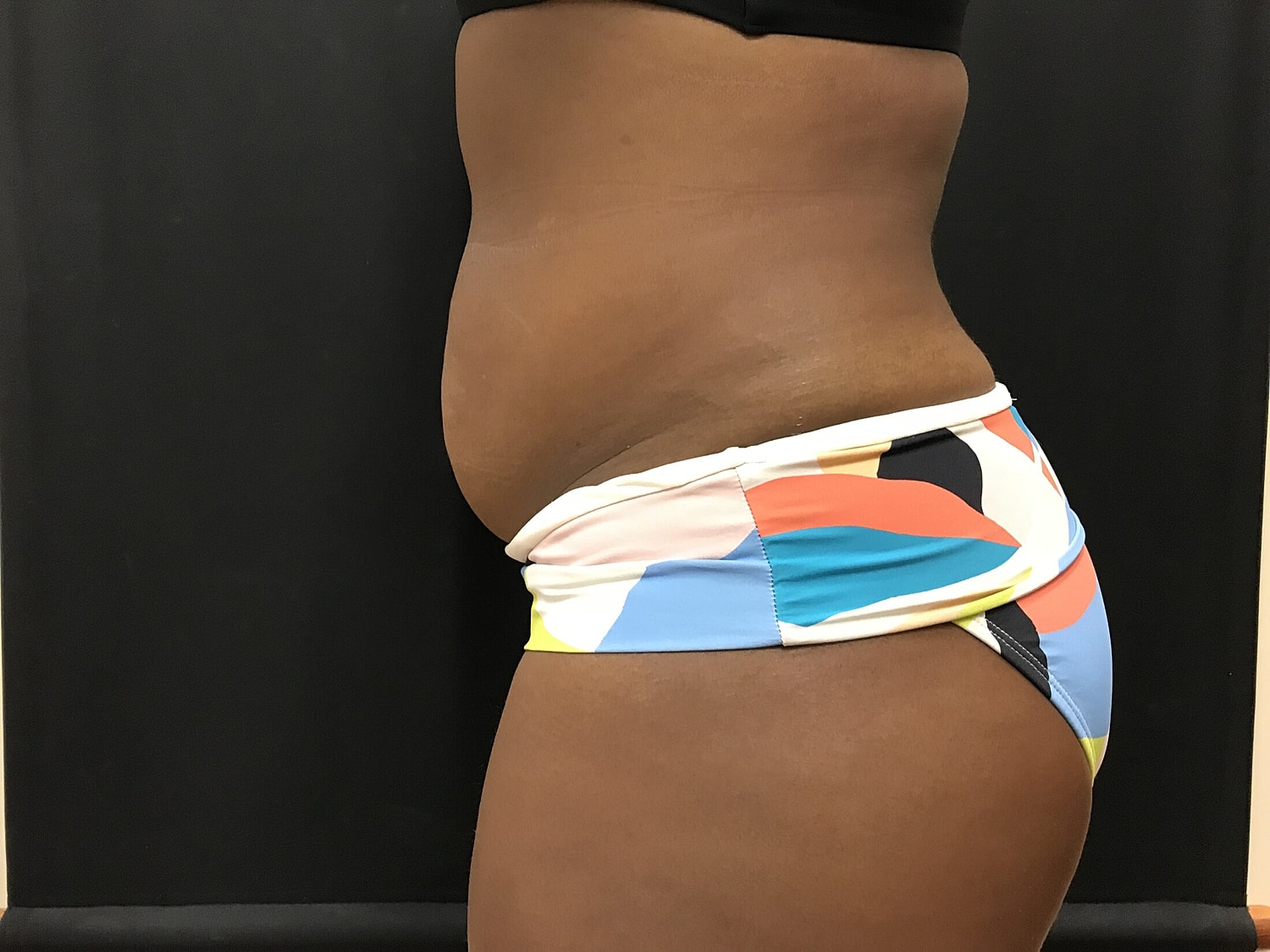 Tummy Tuck Before & After