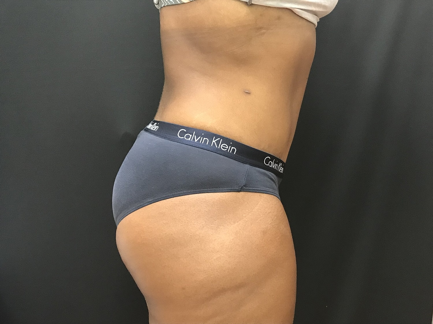 Tummy Tuck Before & After