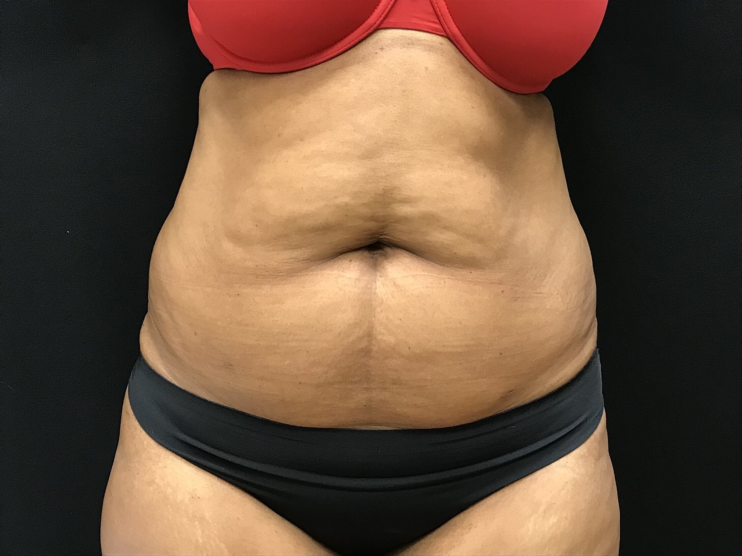 Tummy Tuck Before & After