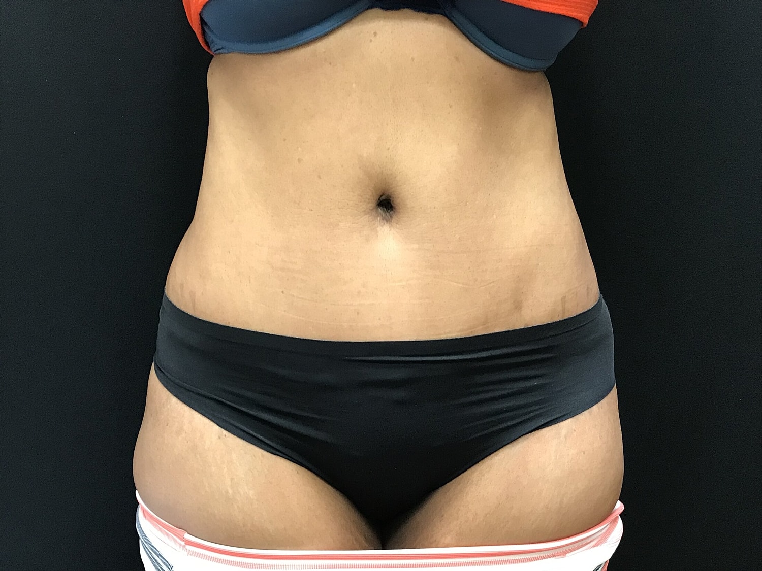 Tummy Tuck Before & After