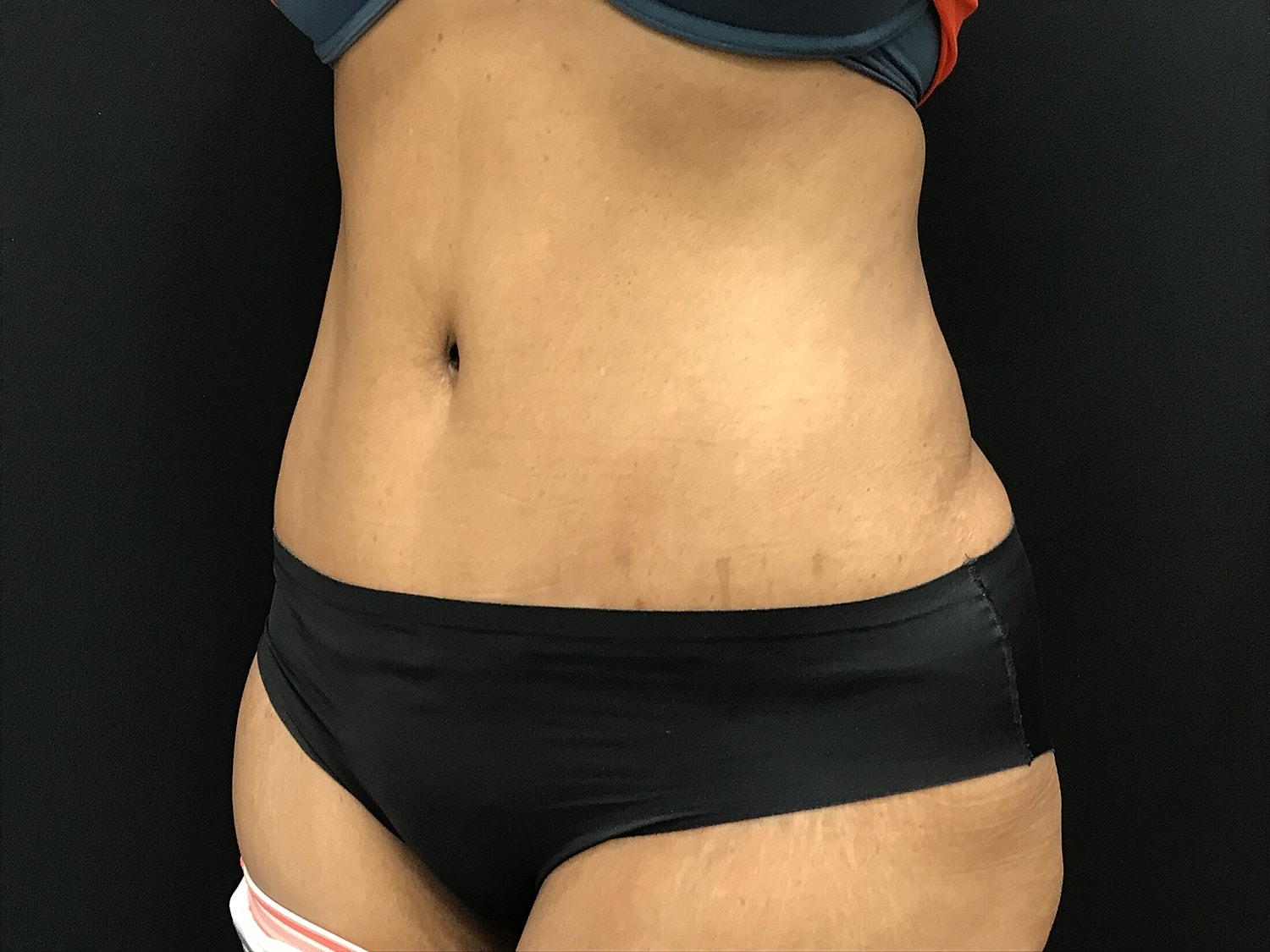 Tummy Tuck Before & After