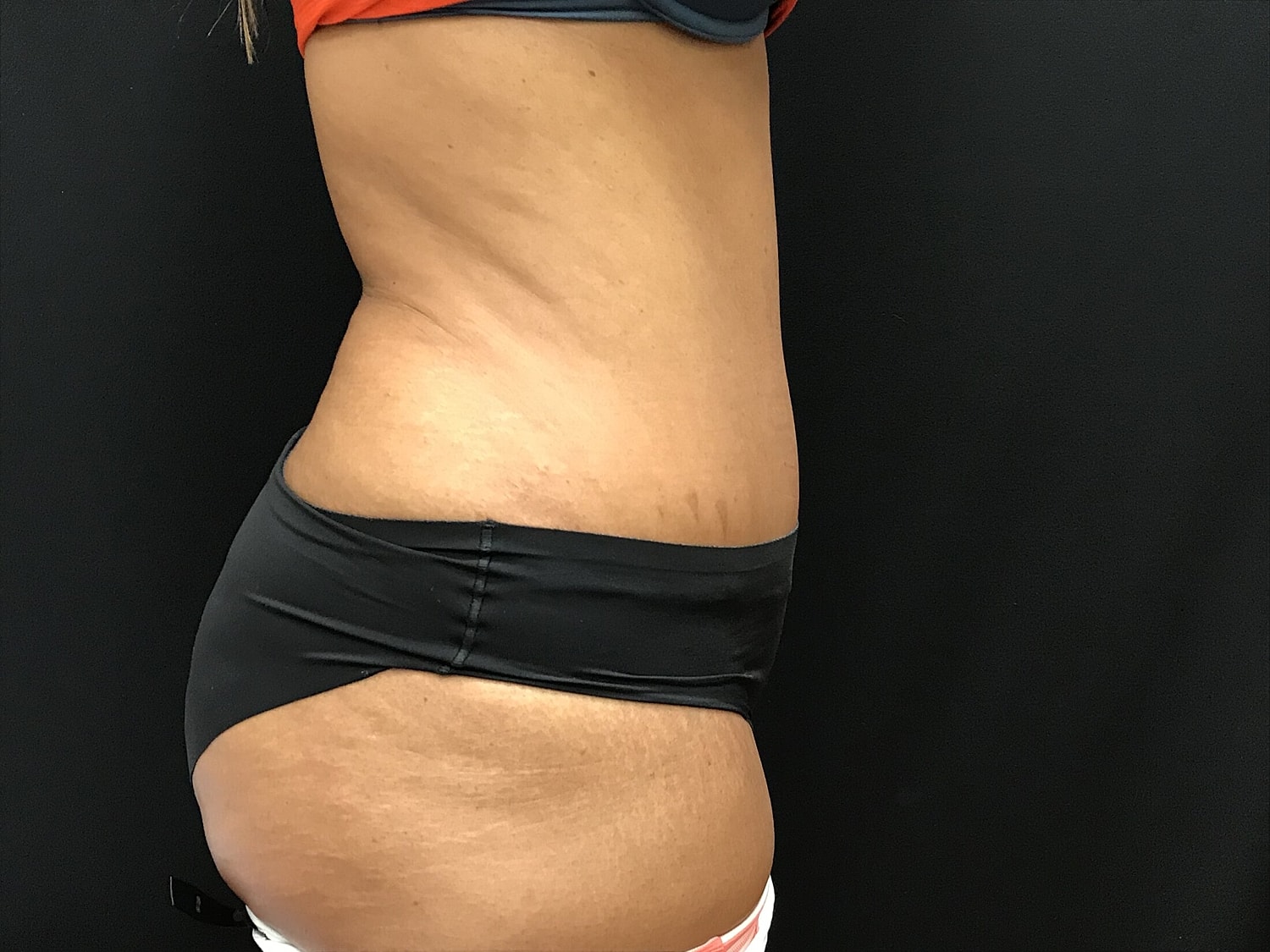 Tummy Tuck Before & After
