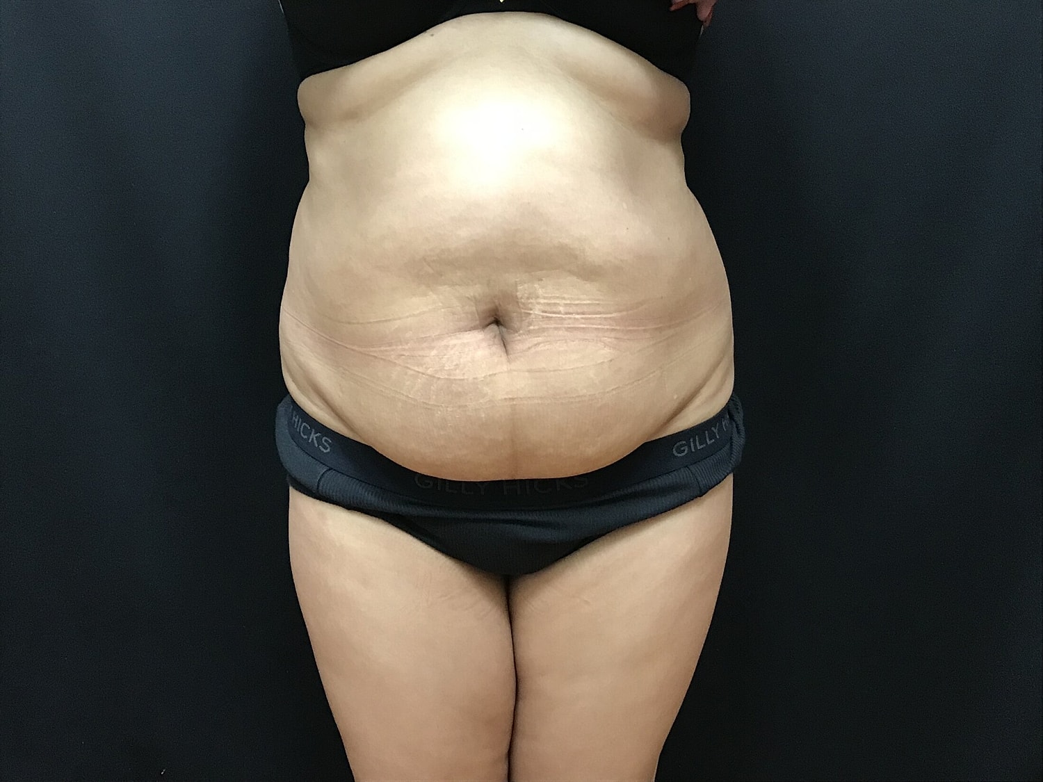 Tummy Tuck Before & After