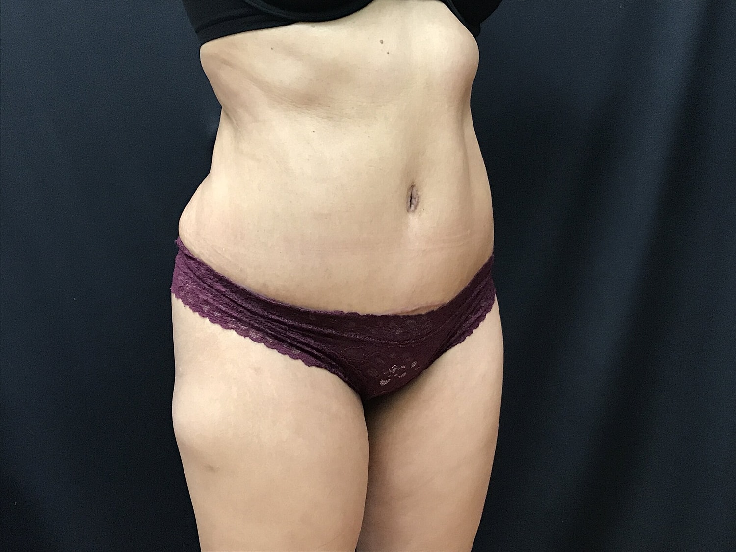 Tummy Tuck Before & After