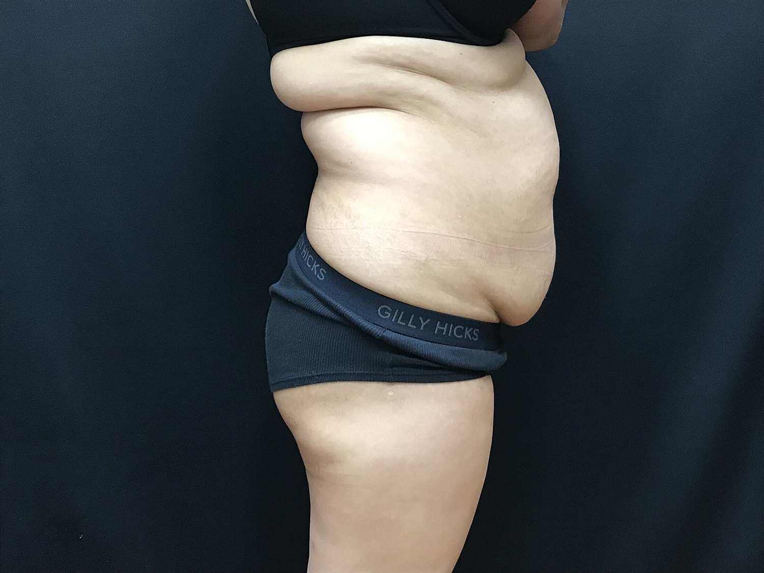 Tummy Tuck Before & After