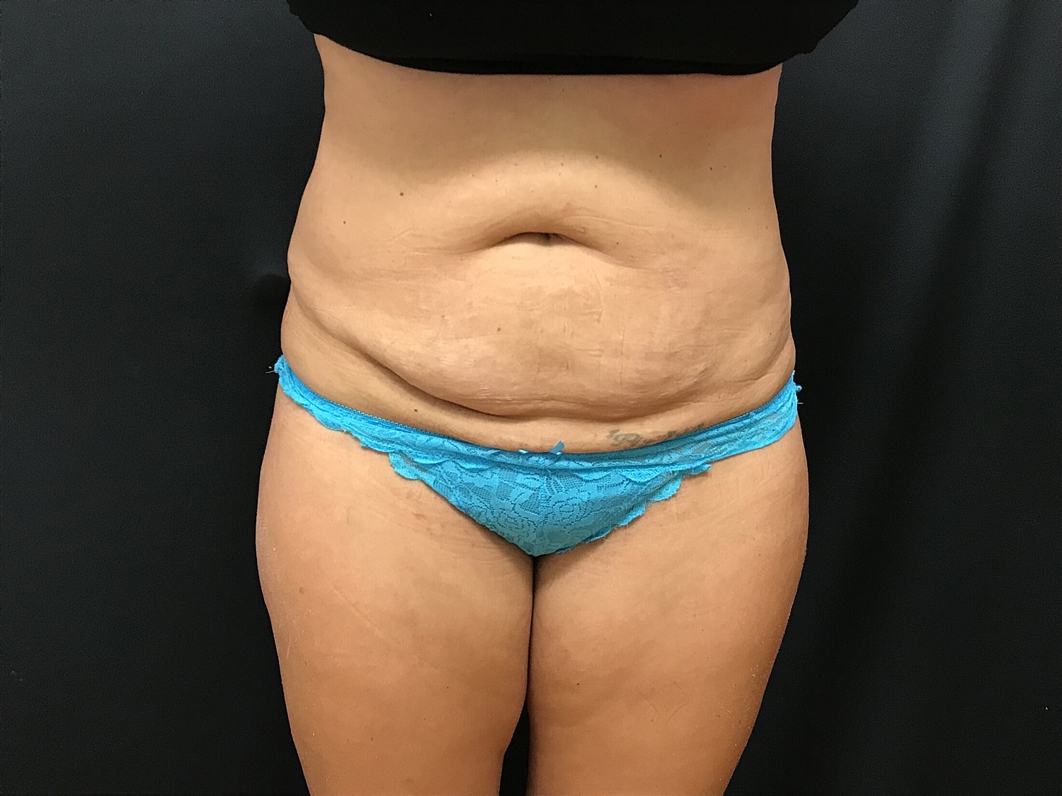 Tummy Tuck Before & After