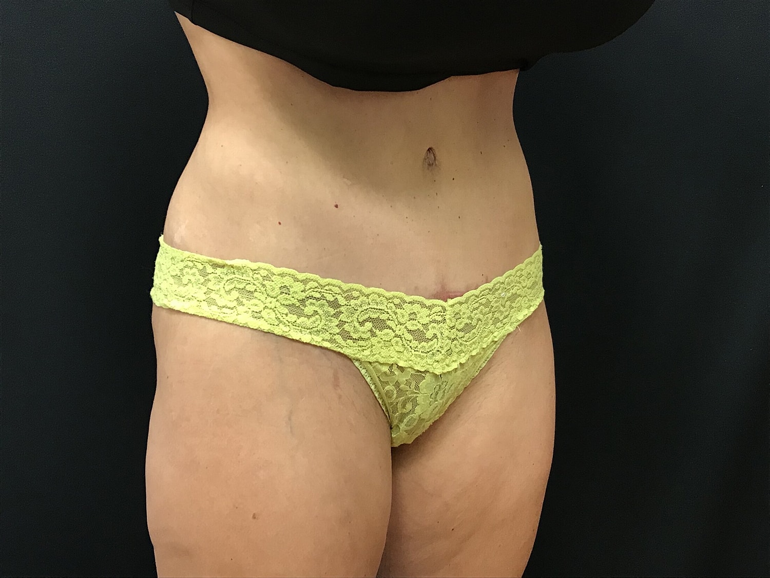 Tummy Tuck Before & After