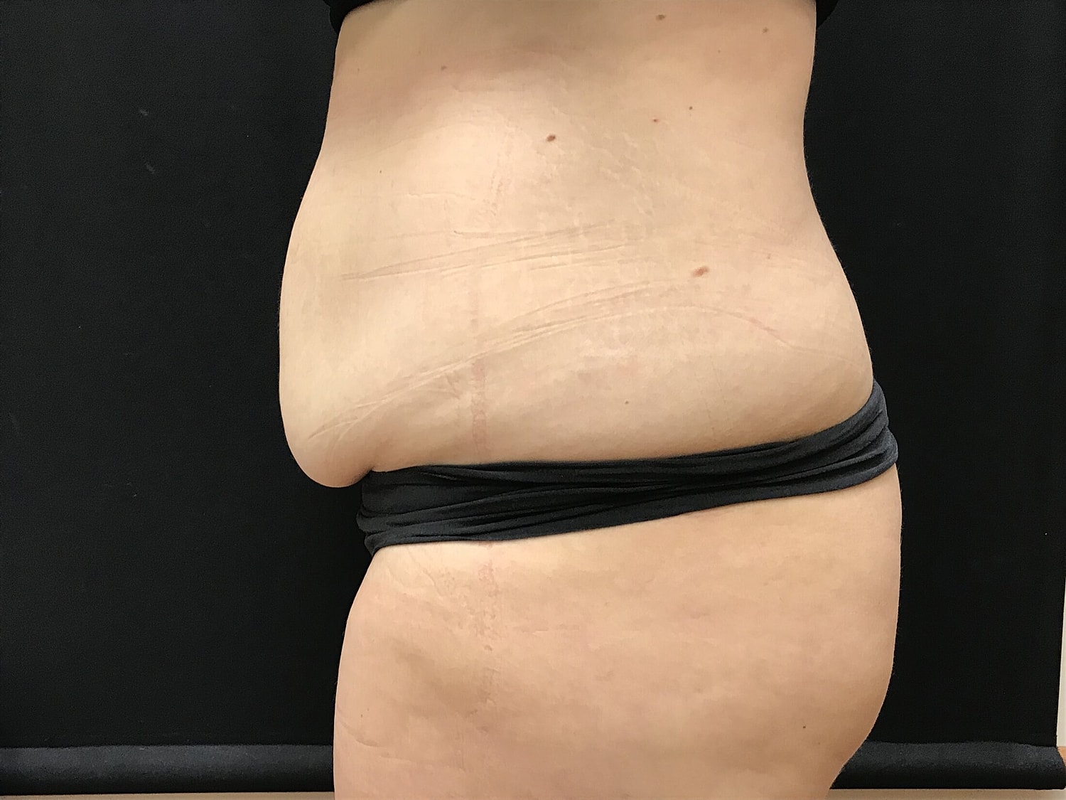 Tummy Tuck Before & After