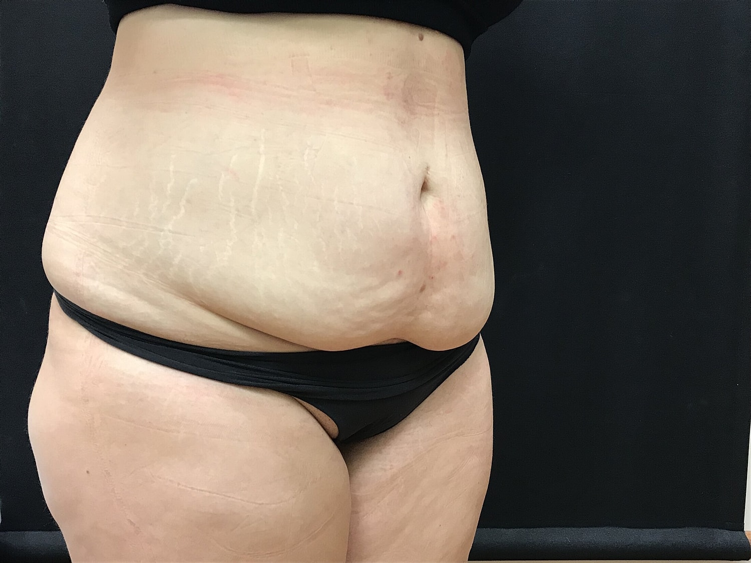 Tummy Tuck Before & After