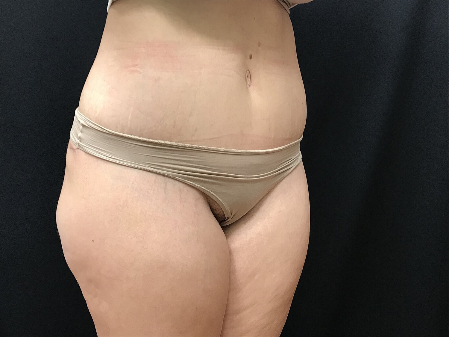 Tummy Tuck Before & After