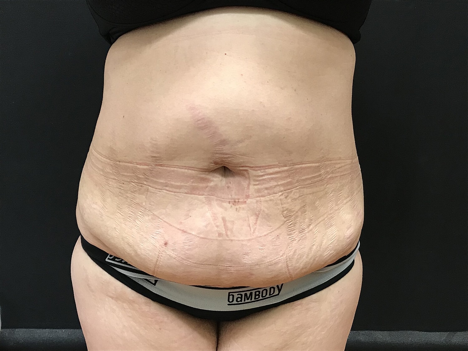 Tummy Tuck Before & After