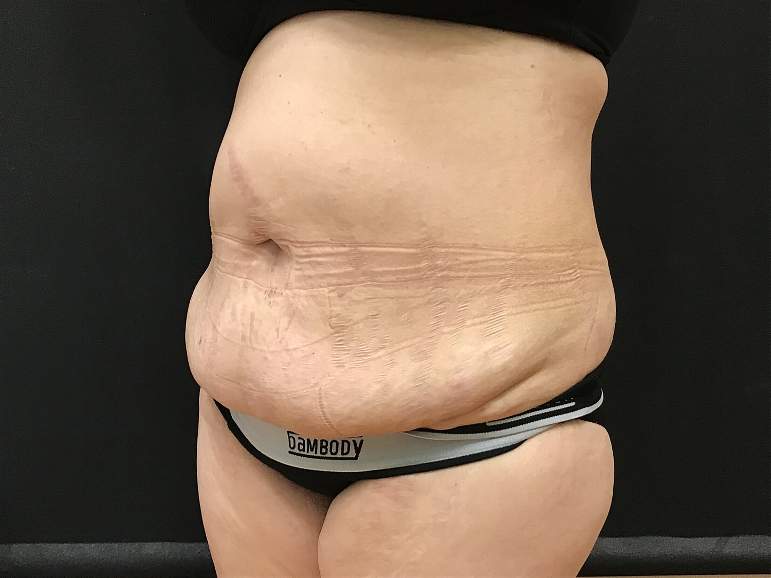 Tummy Tuck Before & After