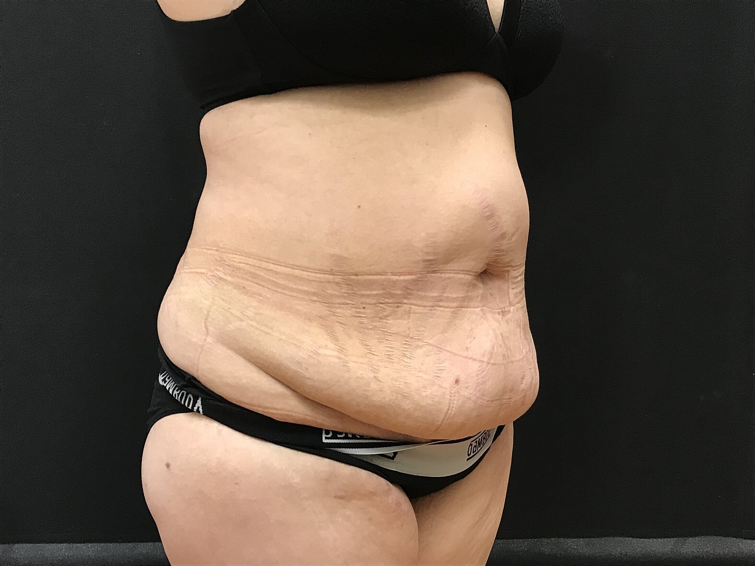 Tummy Tuck Before & After