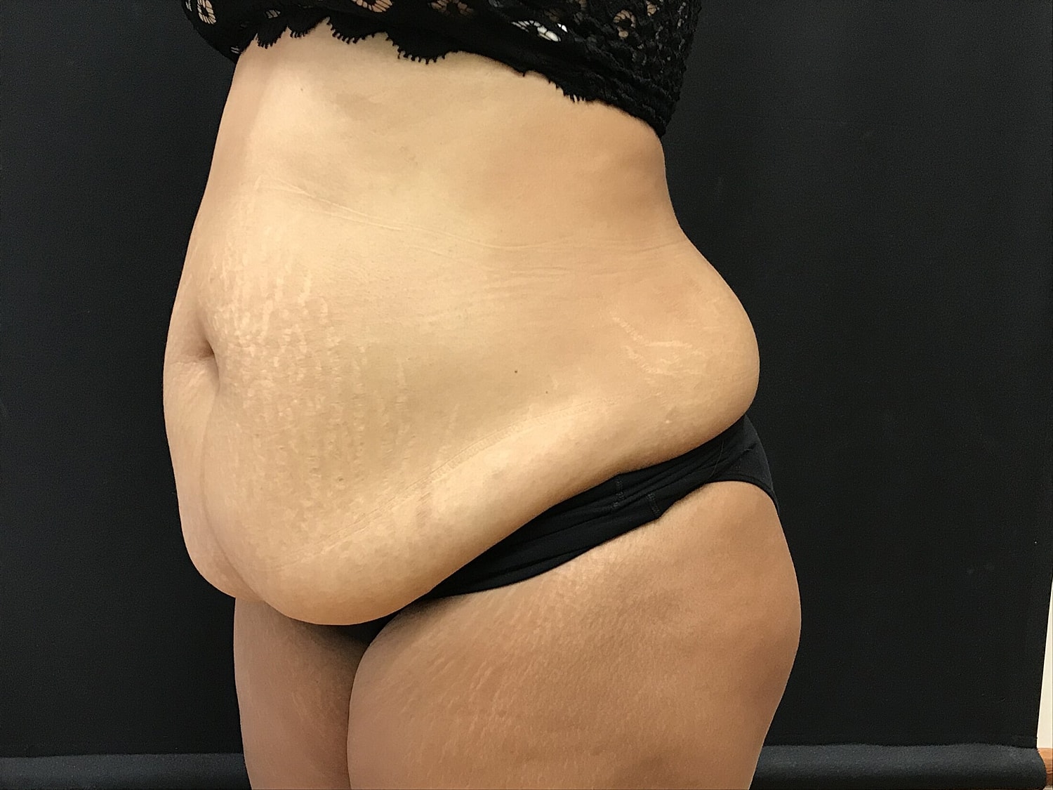 Tummy Tuck Before & After
