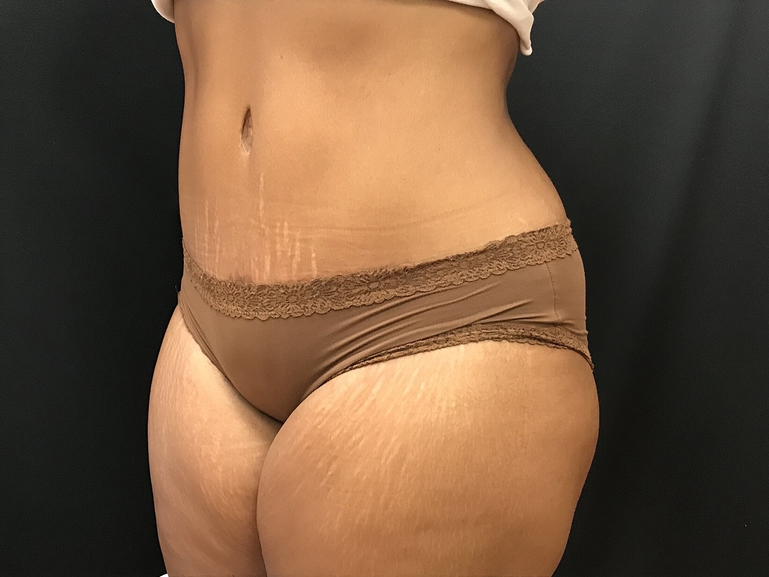 Tummy Tuck Before & After