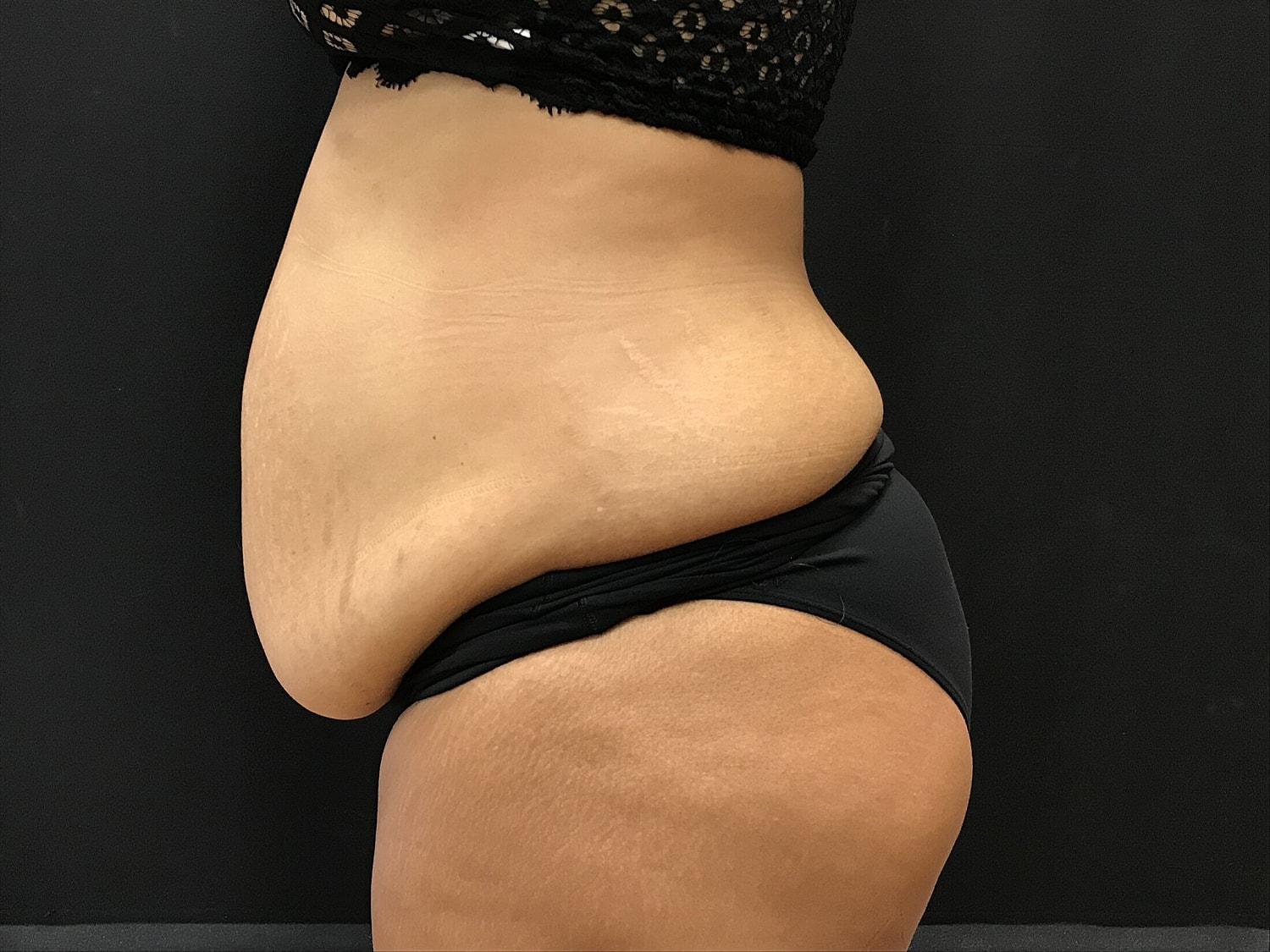 Tummy Tuck Before & After