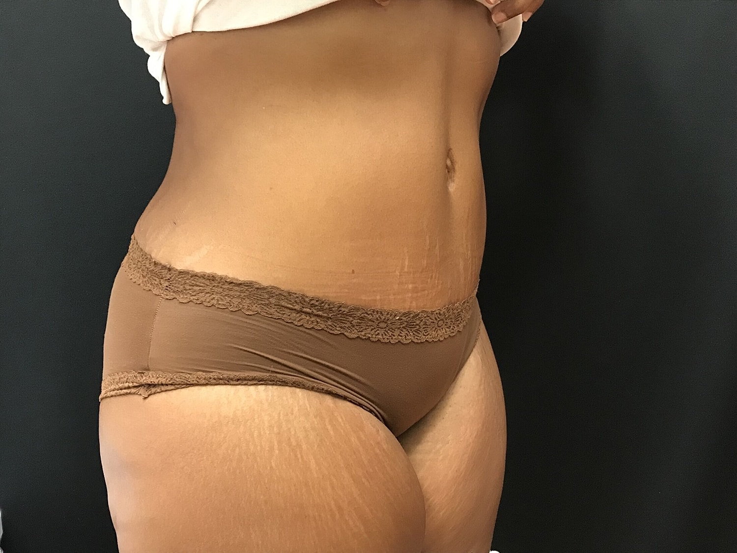 Tummy Tuck Before & After