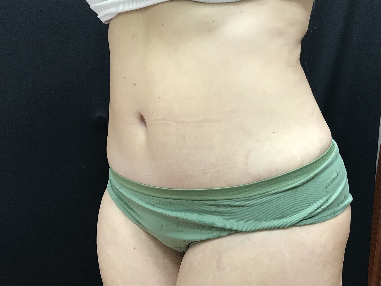 Tummy Tuck Before & After