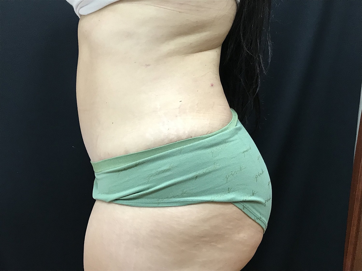 Tummy Tuck Before & After