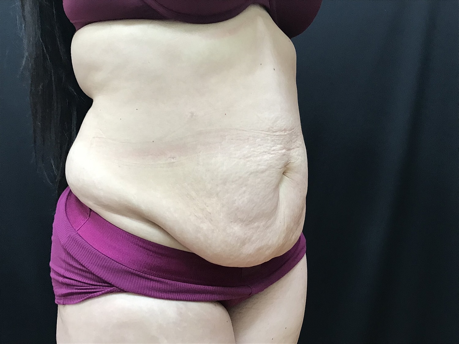 Tummy Tuck Before & After