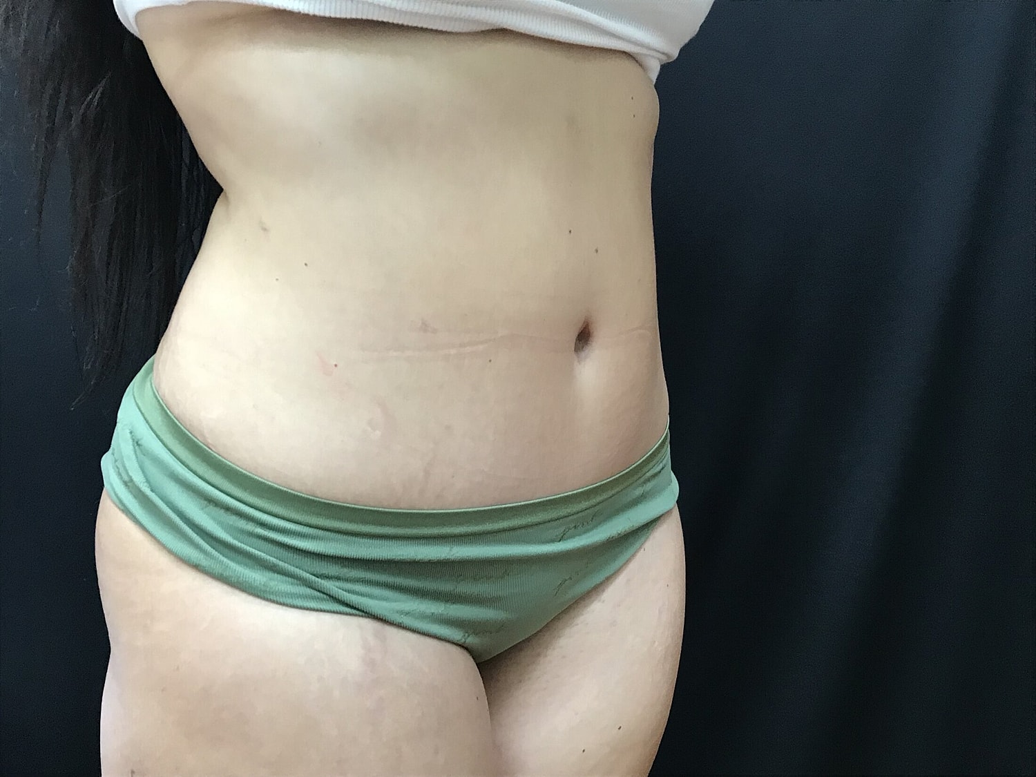 Tummy Tuck Before & After