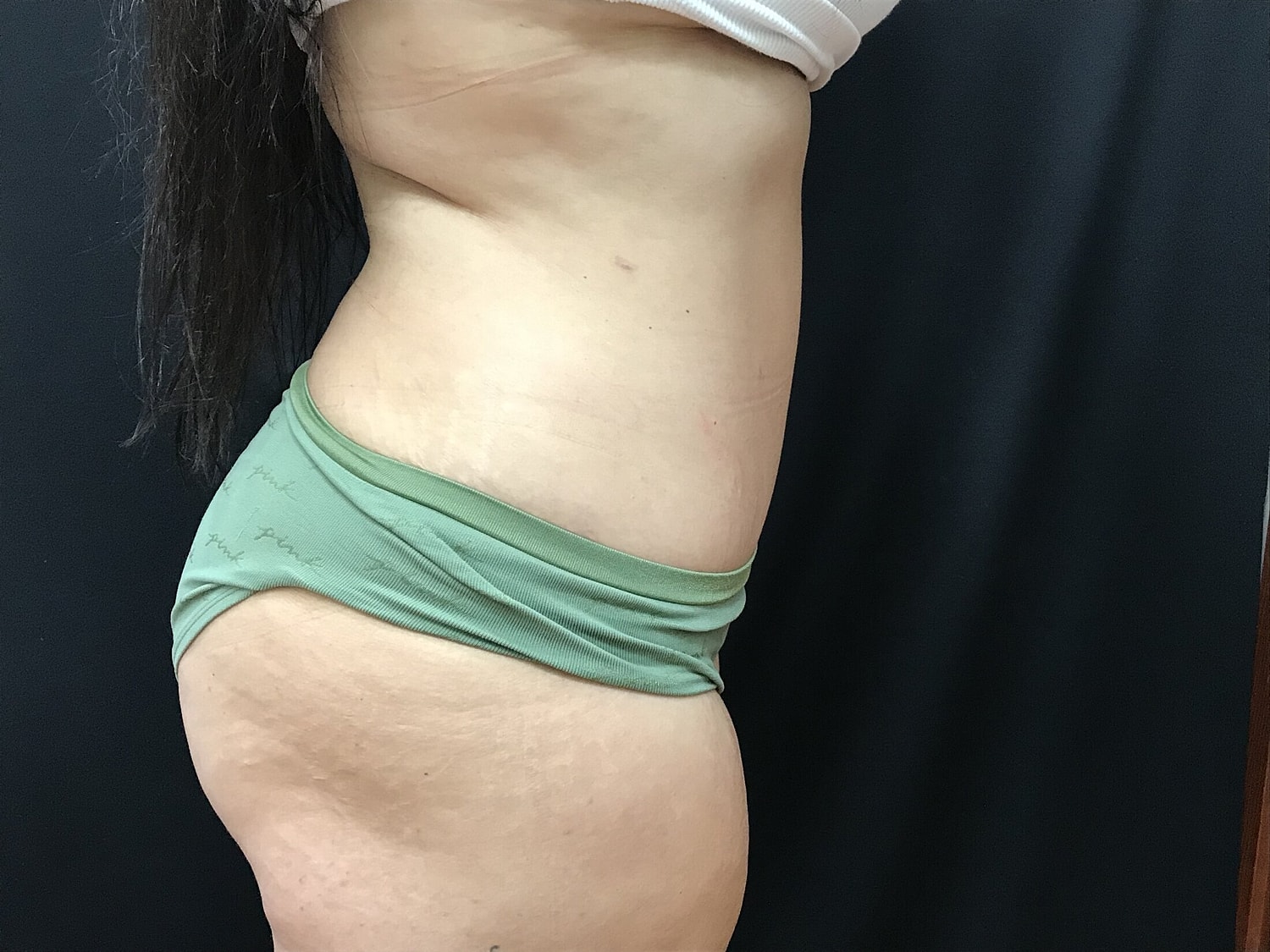 Tummy Tuck Before & After