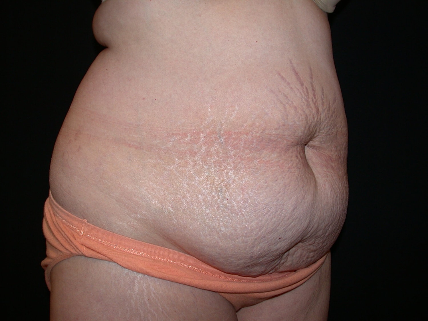 Tummy Tuck Before & After
