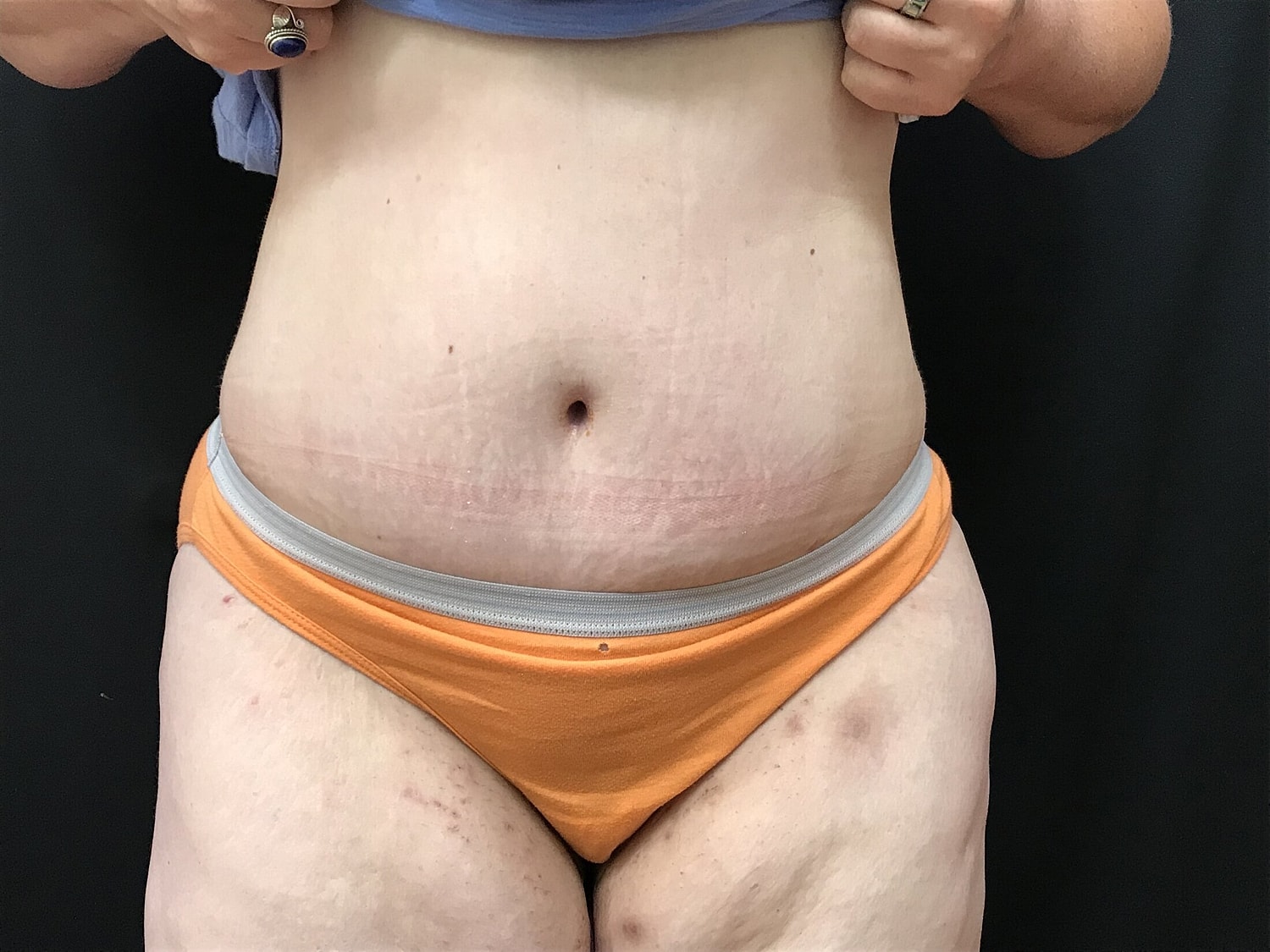 Tummy Tuck Before & After