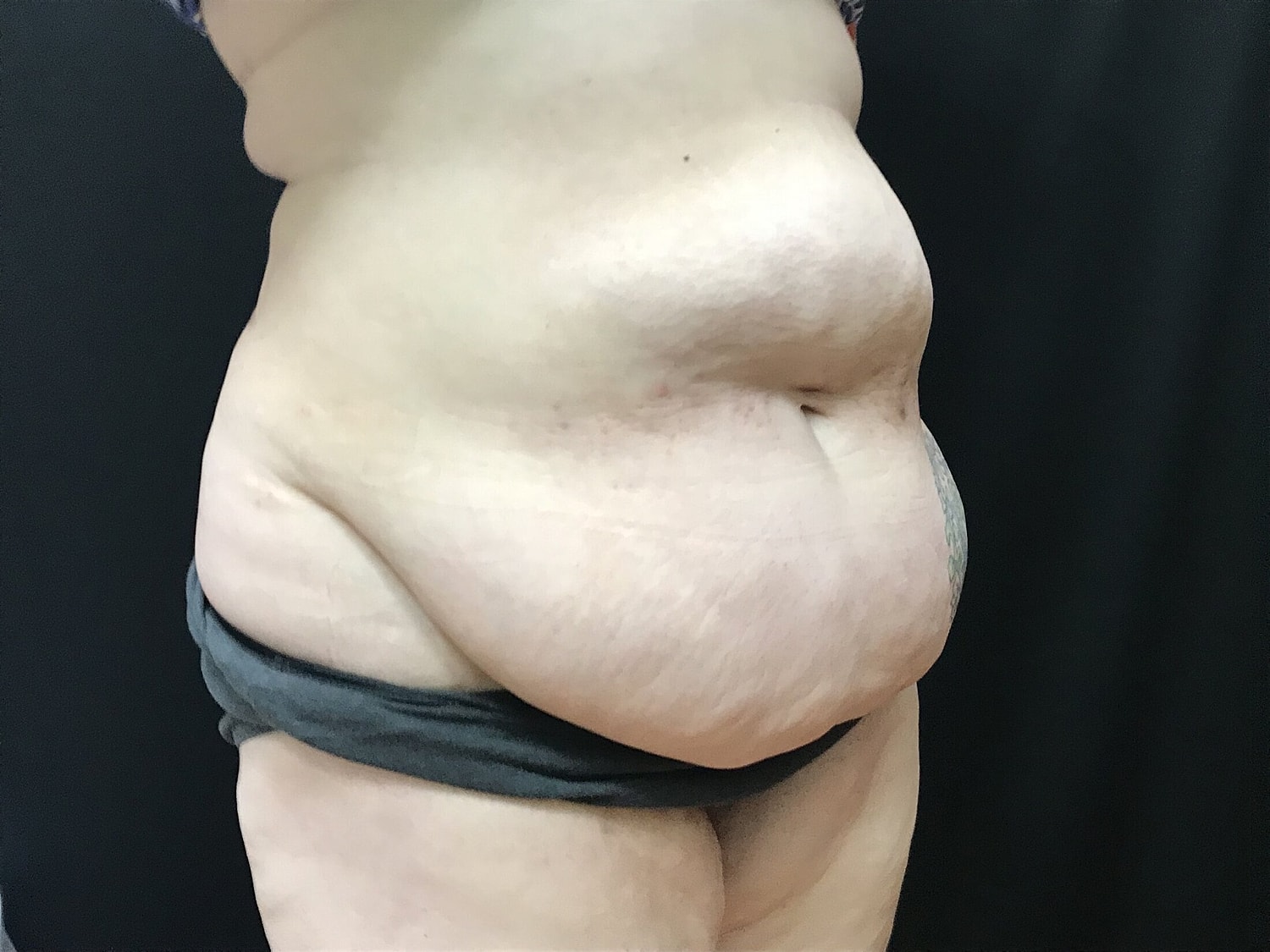 Tummy Tuck Before & After