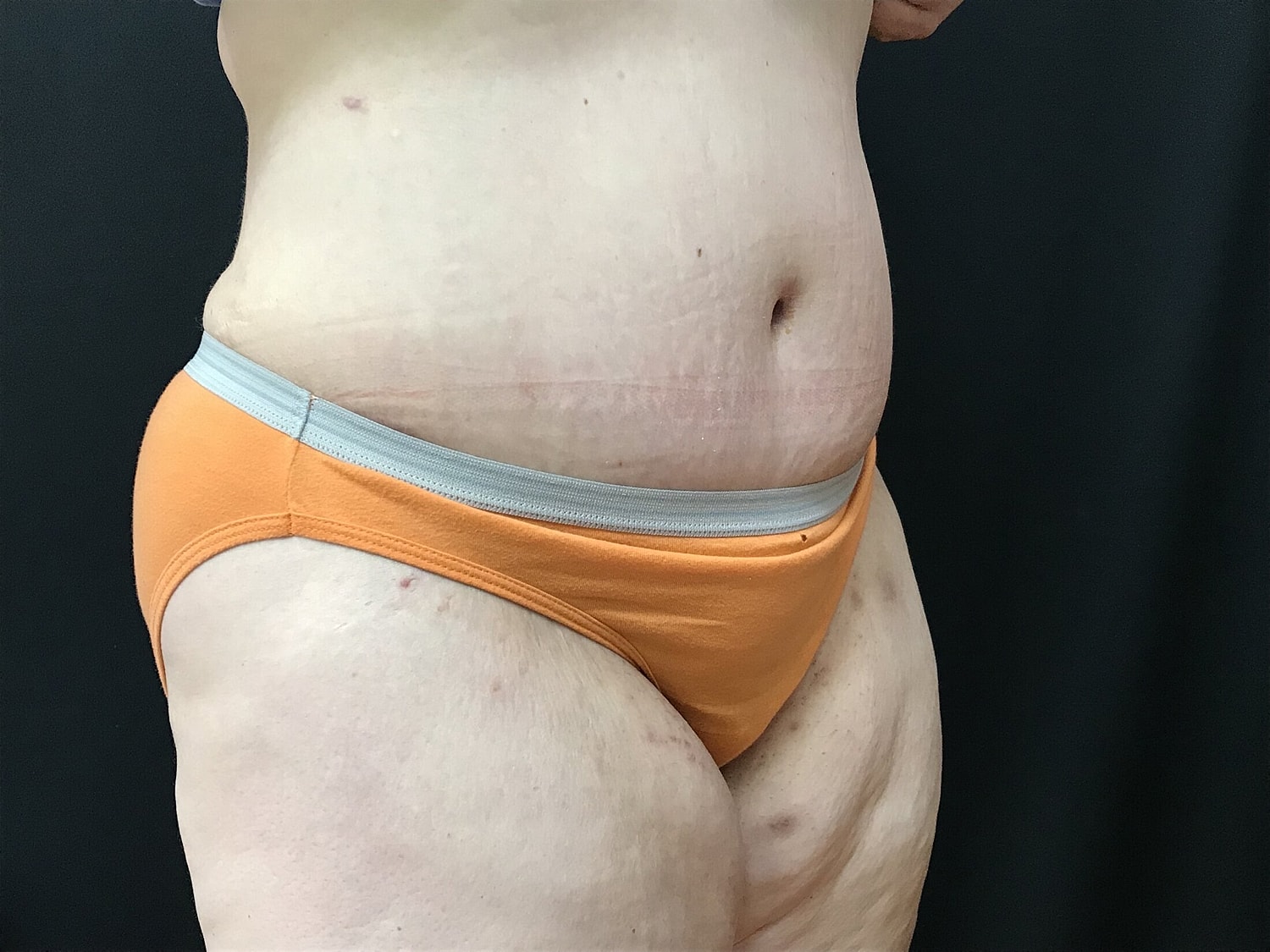 Tummy Tuck Before & After