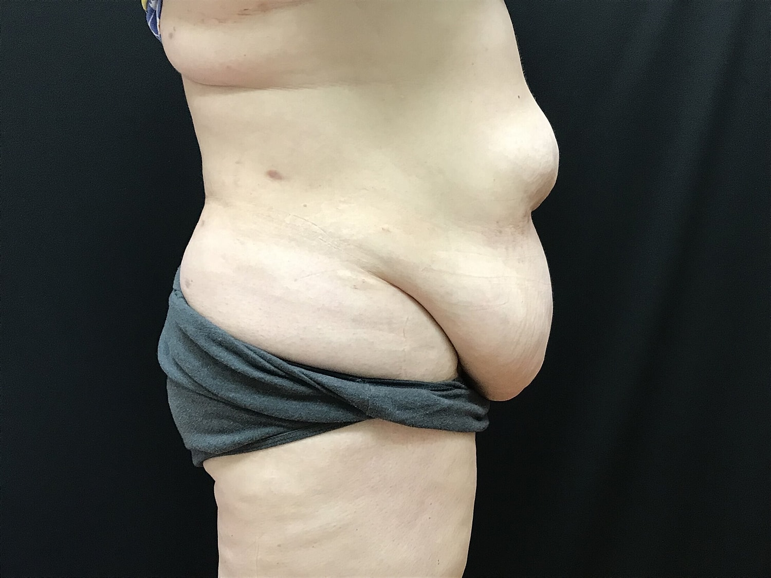Tummy Tuck Before & After