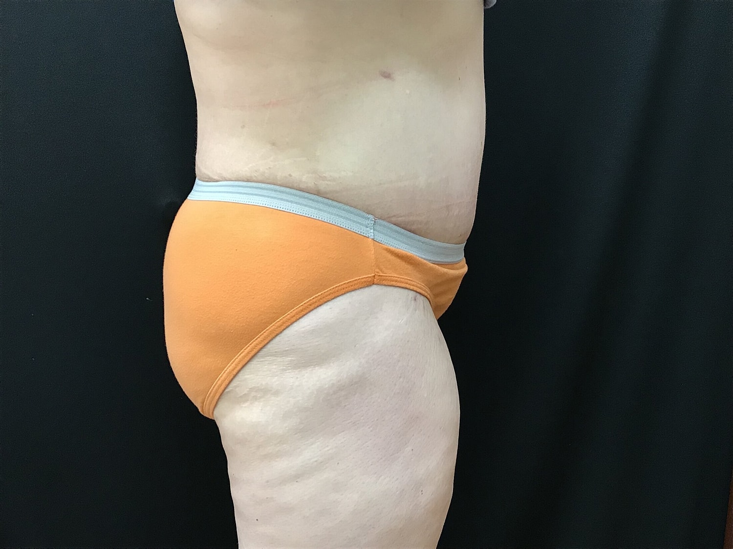 Tummy Tuck Before & After