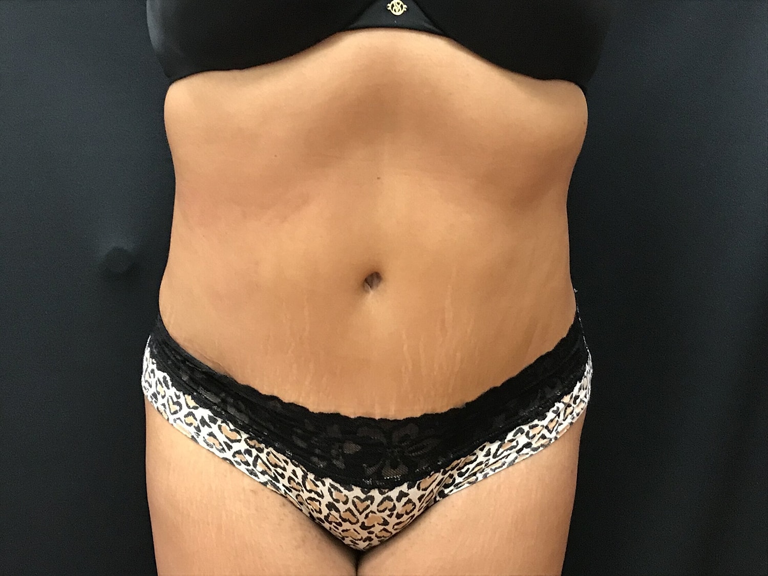 Tummy Tuck Before & After