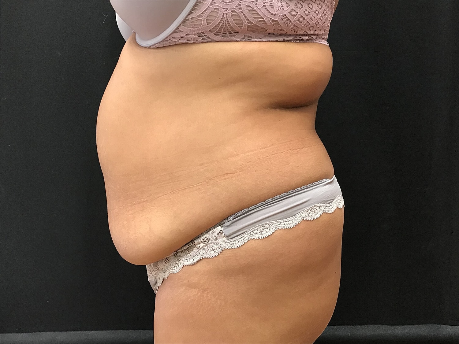 Tummy Tuck Before & After