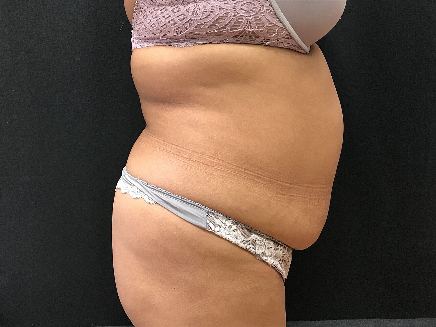 Tummy Tuck Before & After