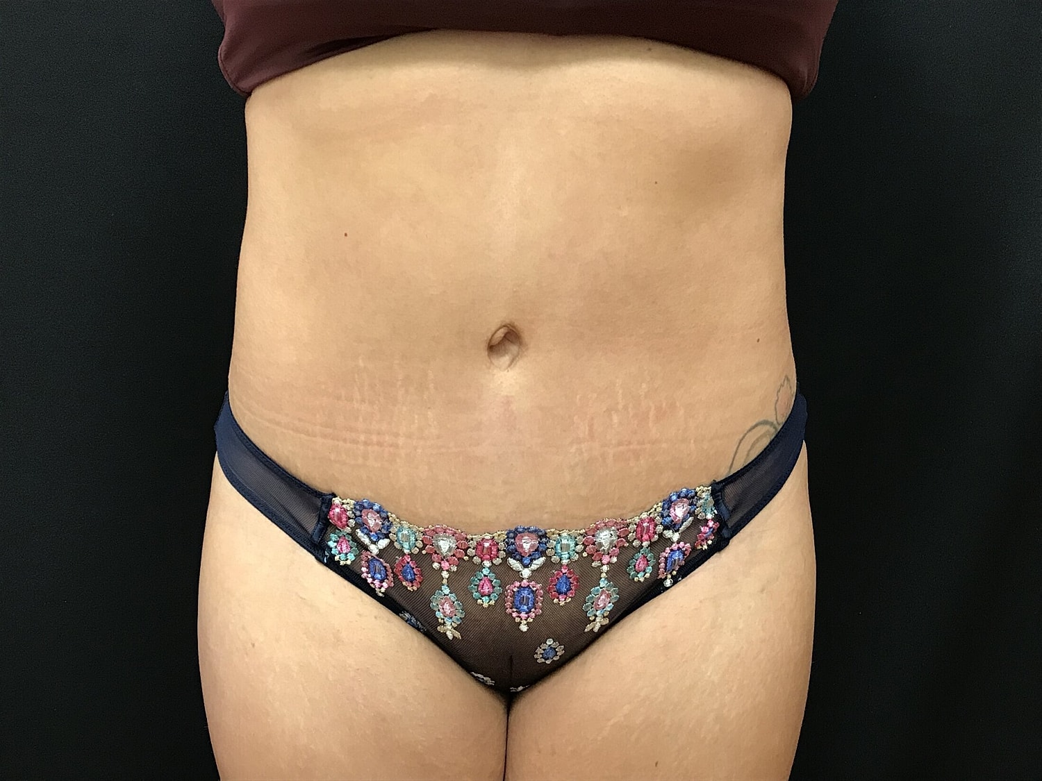 Tummy Tuck Before & After