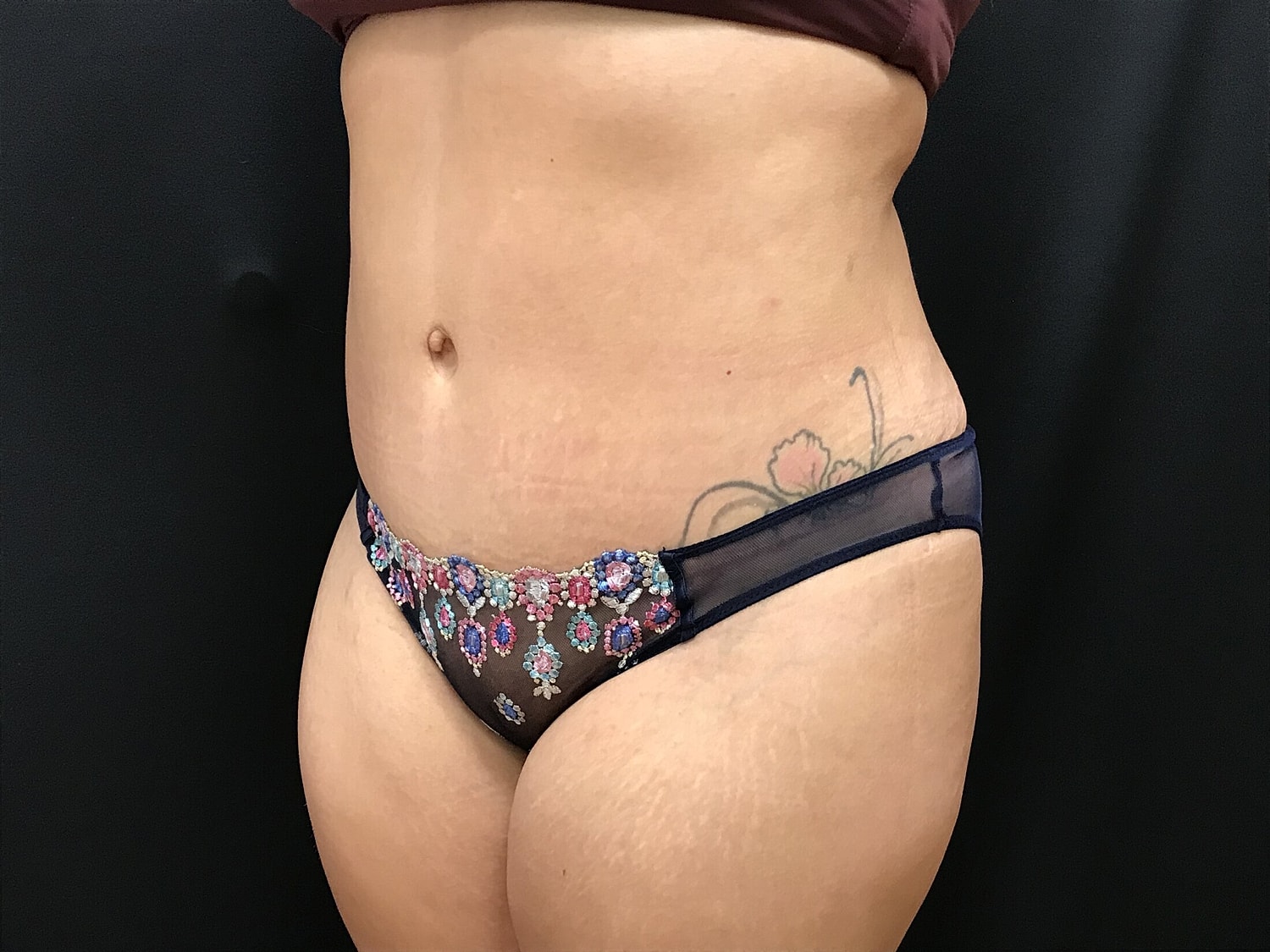 Tummy Tuck Before & After