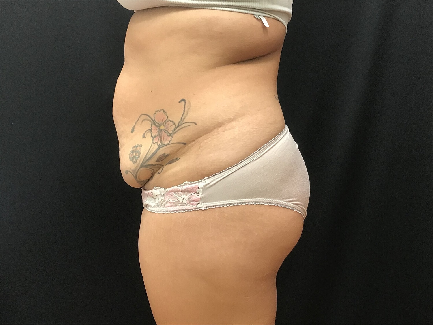 Tummy Tuck Before & After