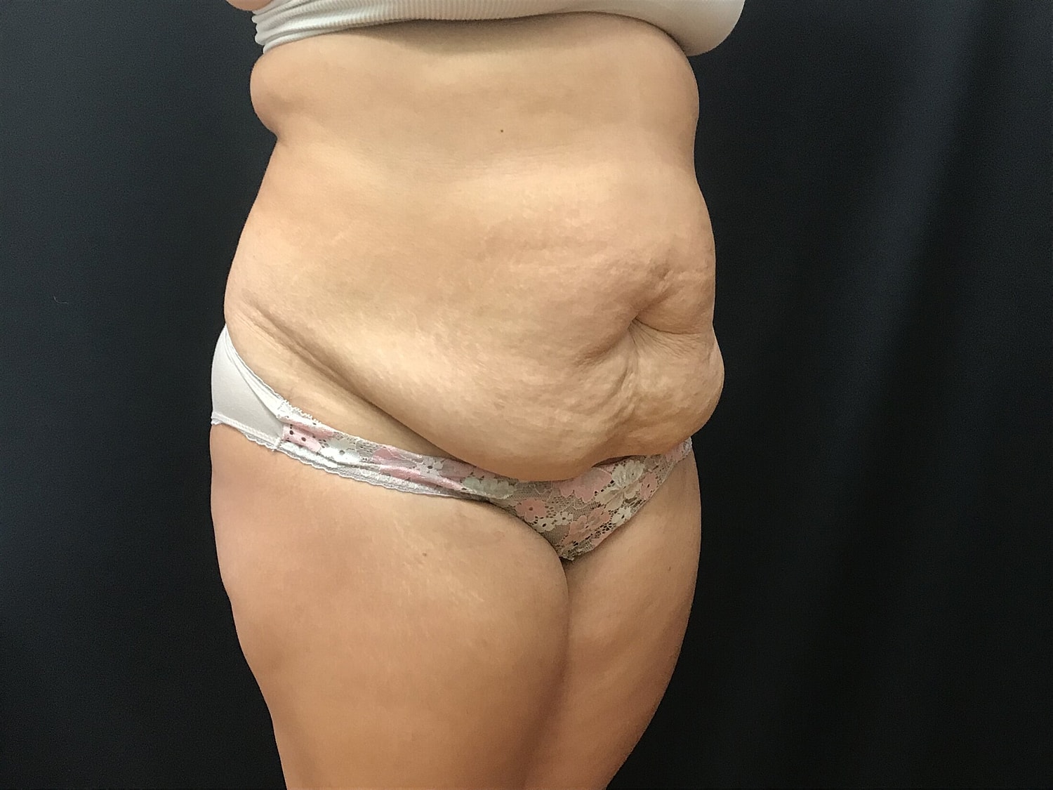 Tummy Tuck Before & After