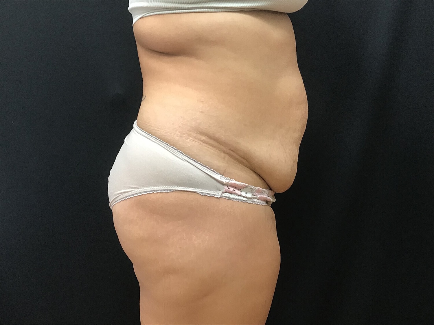 Tummy Tuck Before & After