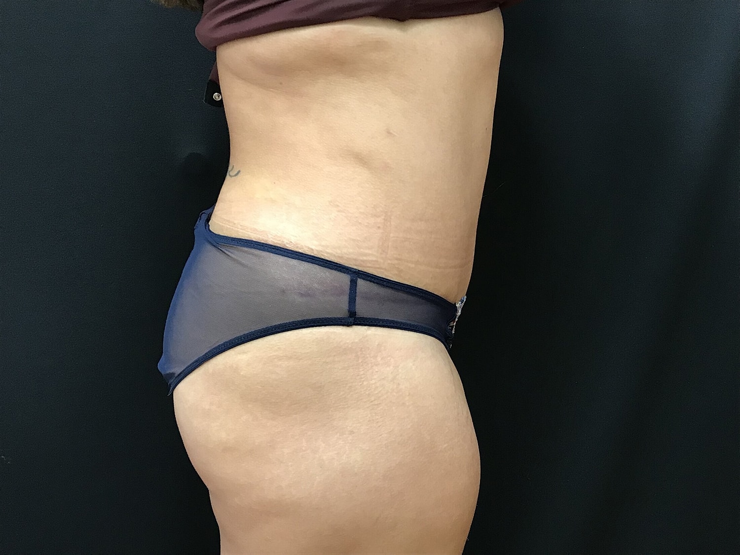 Tummy Tuck Before & After