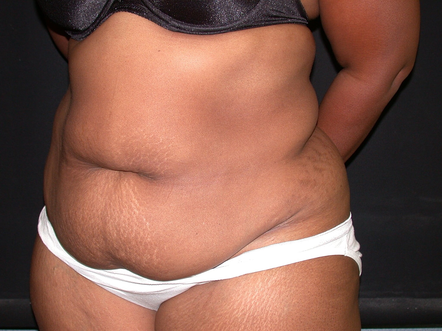 Tummy Tuck Before & After