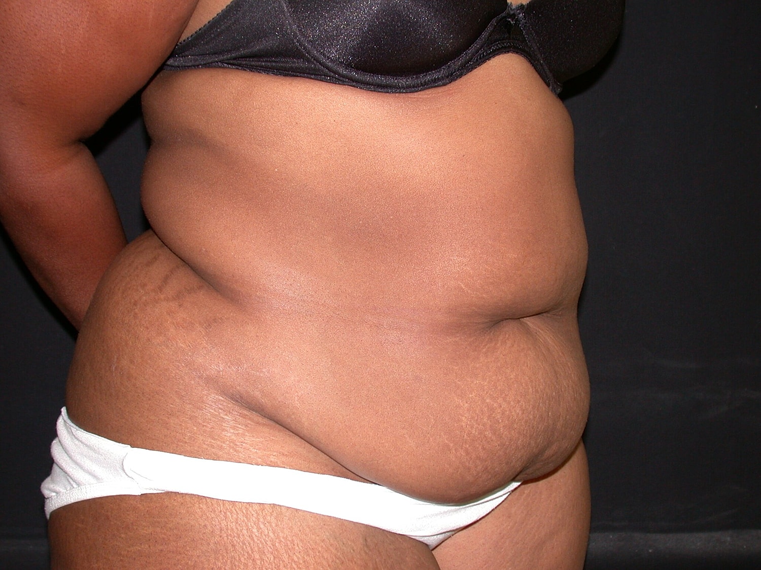 Tummy Tuck Before & After