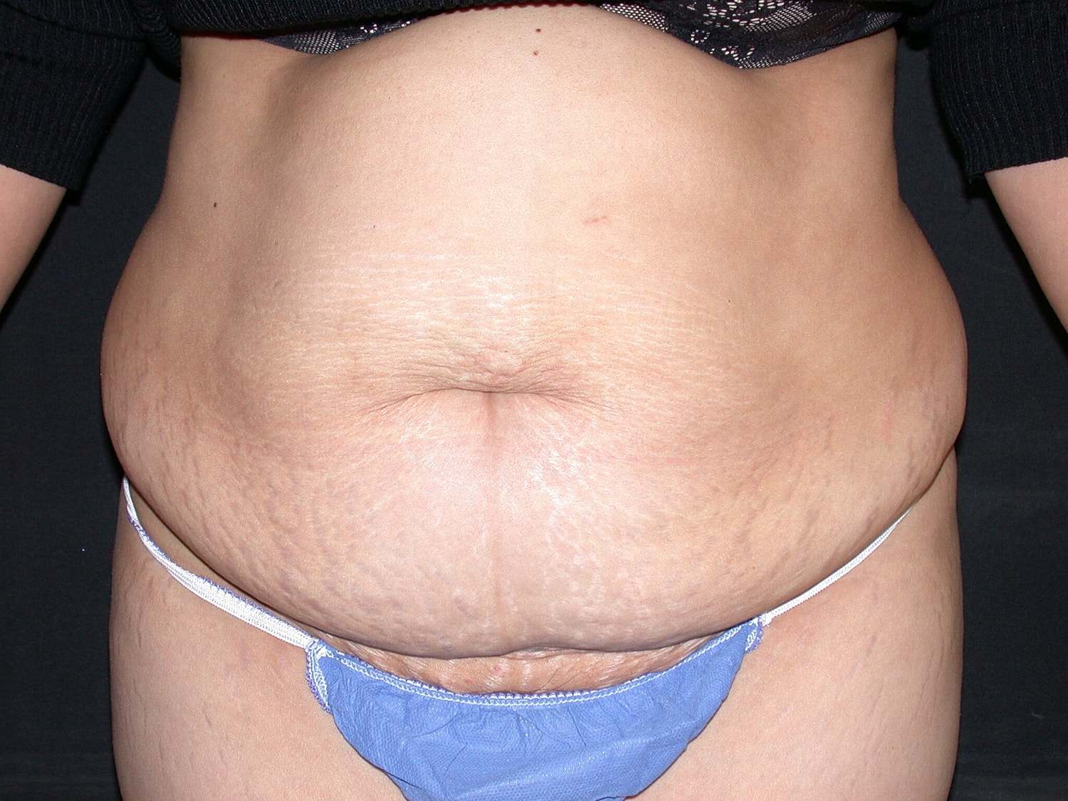 Tummy Tuck Before & After