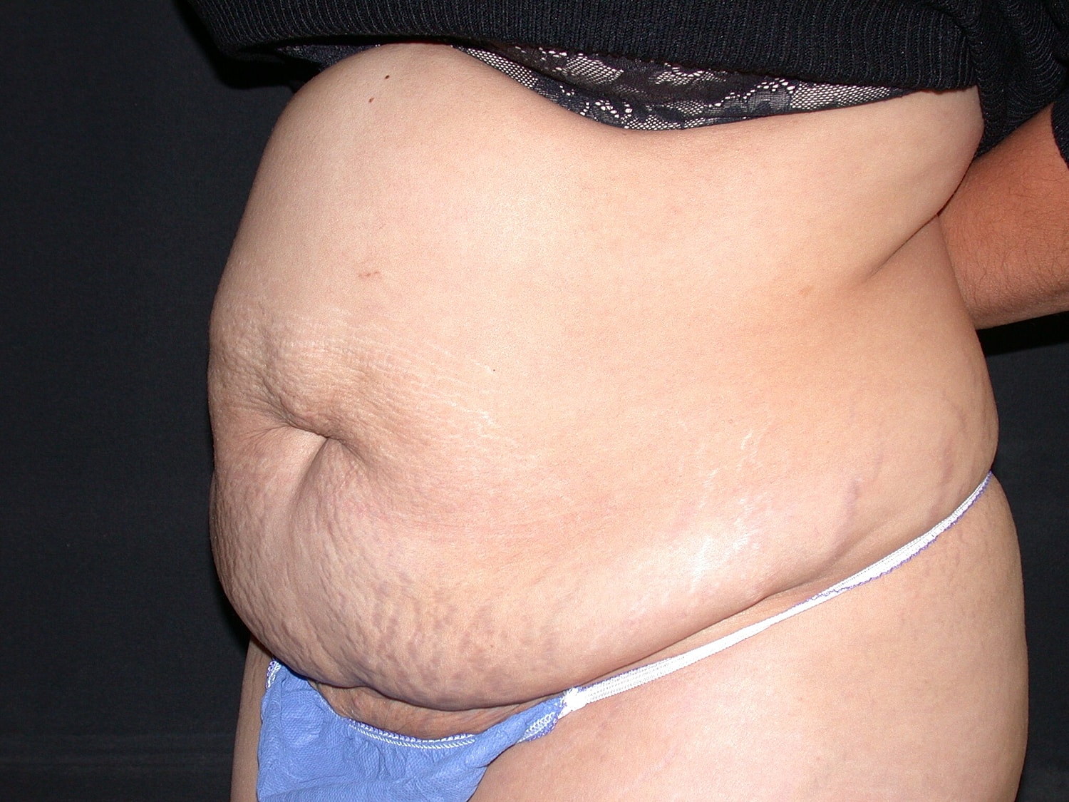 Tummy Tuck Before & After