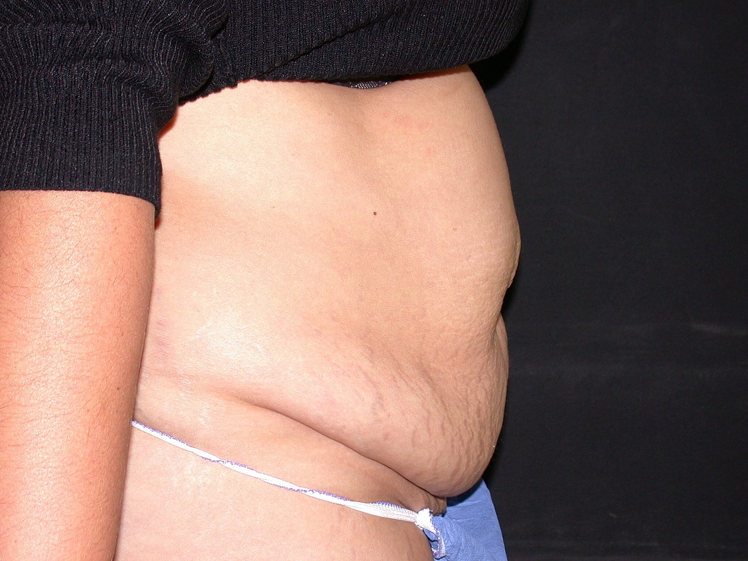 Tummy Tuck Before & After
