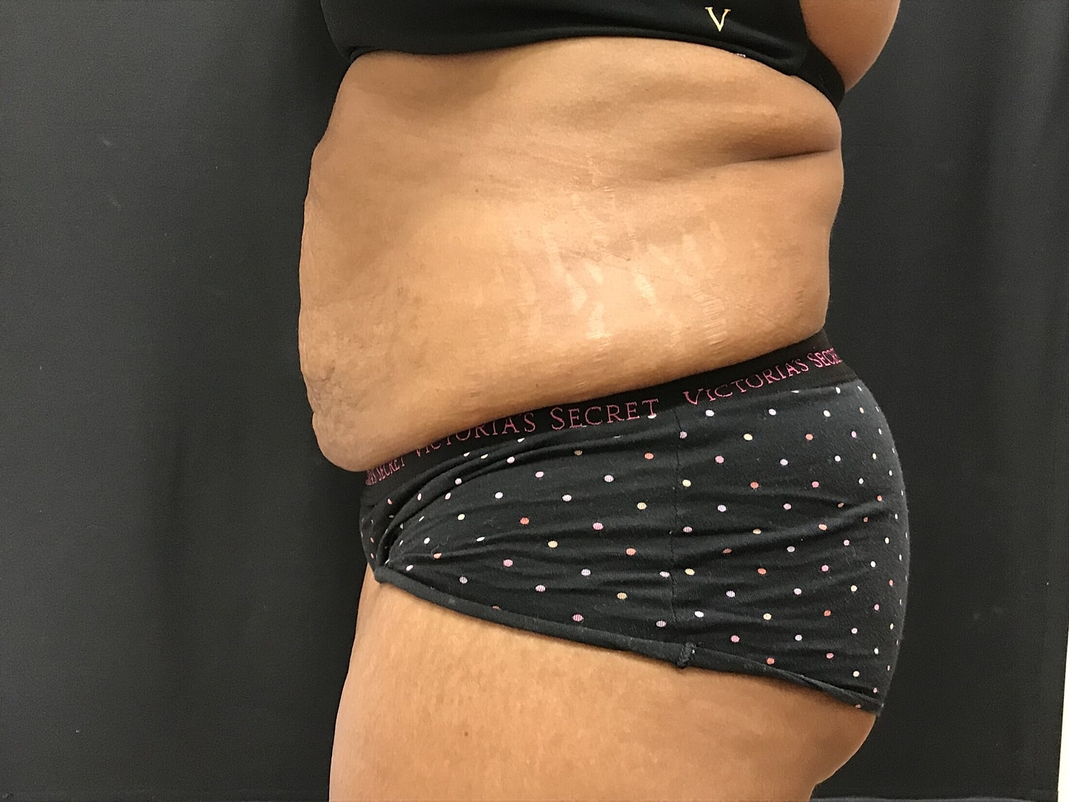 Tummy Tuck Before & After