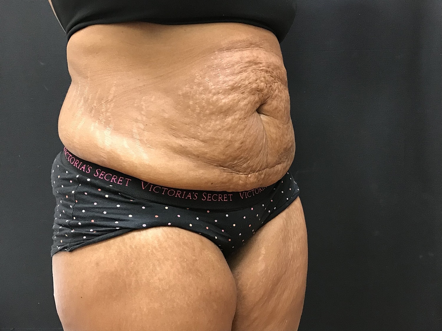 Tummy Tuck Before & After