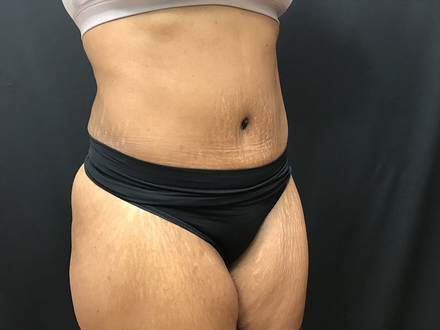 Tummy Tuck Before & After